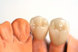 dental crown procedure in Arlington Heights IL