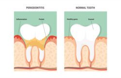 engelberg periodontal disease