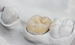 Dental Restorations at AH Smiles in Arlington Heights IL