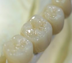 Same Day Dental Crowns in Arlington Heights IL