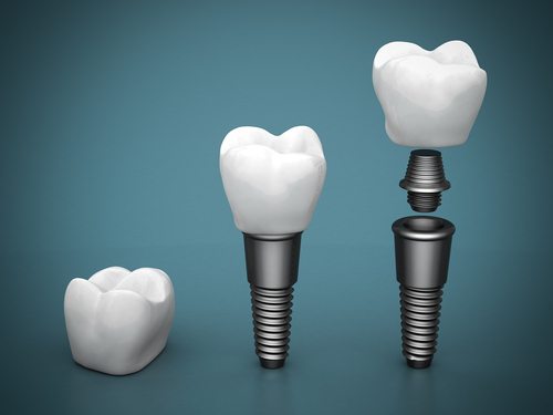 Dental implants in Arlington Heights IL