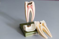 Root Canal Therapy in Arlington Heights IL