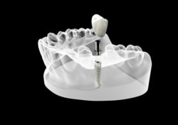 dental implants FAQ in Arlington Heights IL with Dr Engelberg