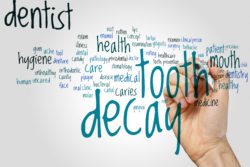 Cavity prevention in Arlington Heights IL with Dr. Engelberg