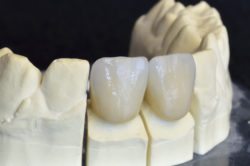 CEREC Same Day Dental Crowns in Arlington Heights IL