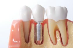 Generic dental teeth model arlington heights