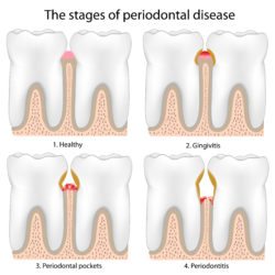 Treating periodontal disease in Arlington Heights IL