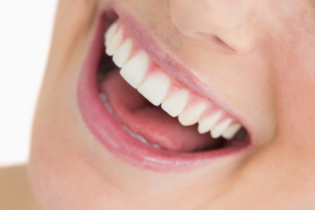 porcelain veneers in Arlington Heights Illinois