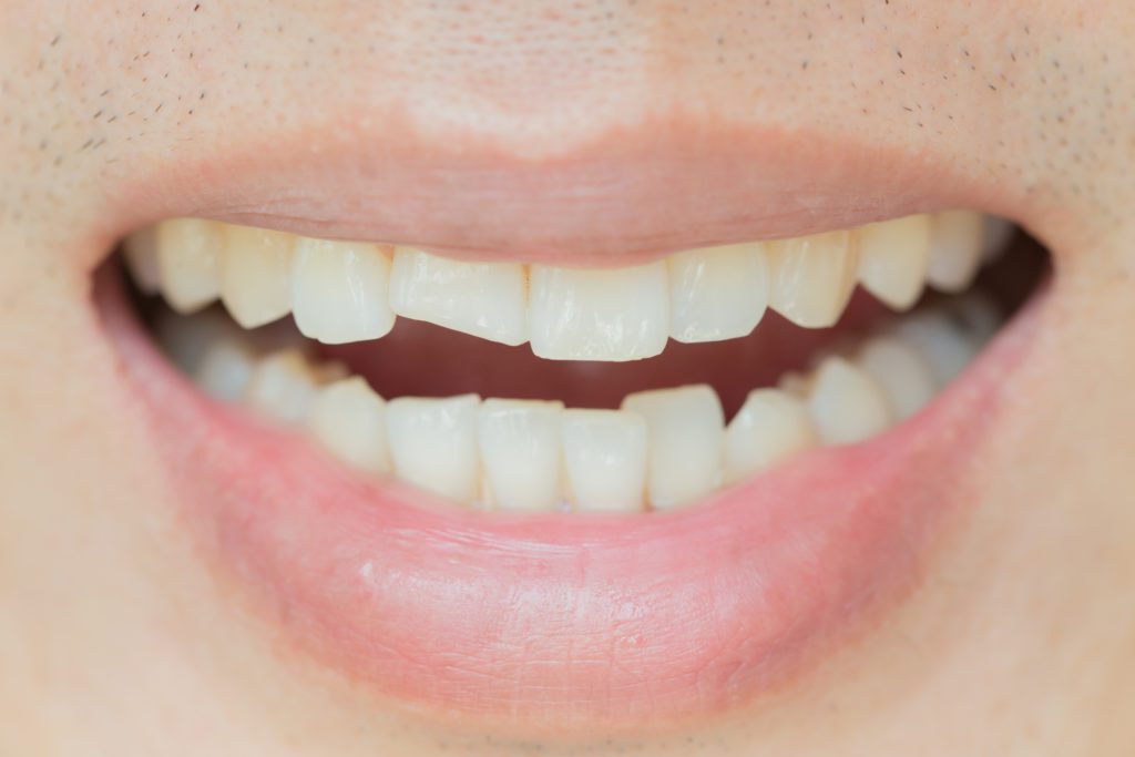 Do You Grind Your Teeth Arlington Heights IL