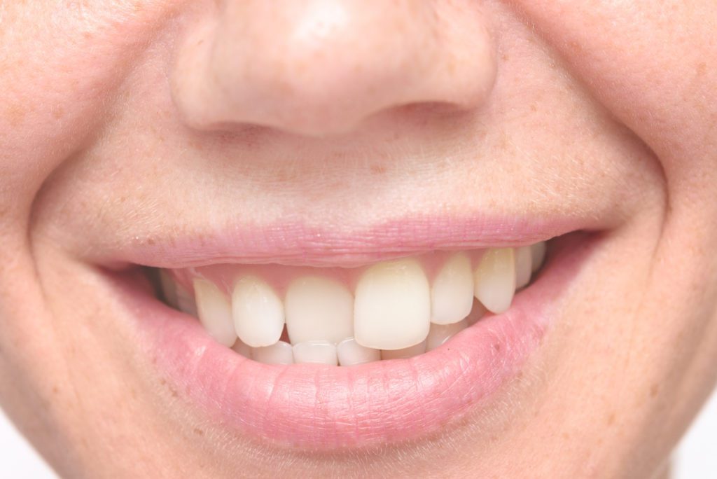 Top questions you should ask your dentist about Invisalign Arlington Heights IL