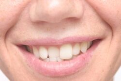 Top questions you should ask your dentist about Invisalign Arlington Heights IL