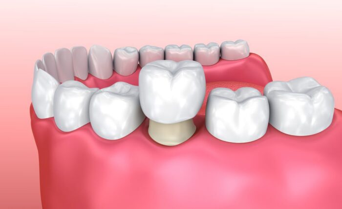 dental crowns and cerec restorations in Arlington Heights Illinois