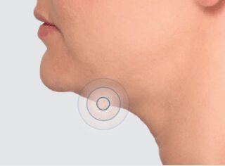Kybella Facial Esthetics treatment in Arlington Heights IL