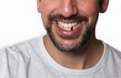 Missing Teeth replacement Arlington Heights IL