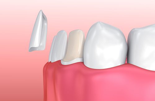 Cosmetic Restorations in Arlington Heights IL