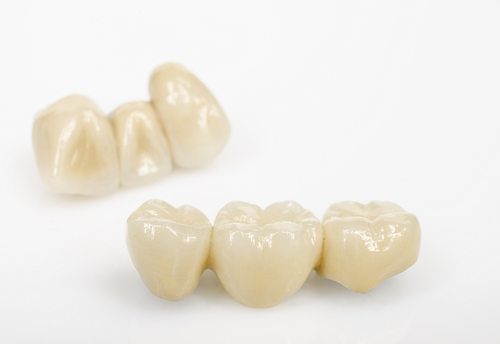 Beautiful dental bridges at AH Smiles