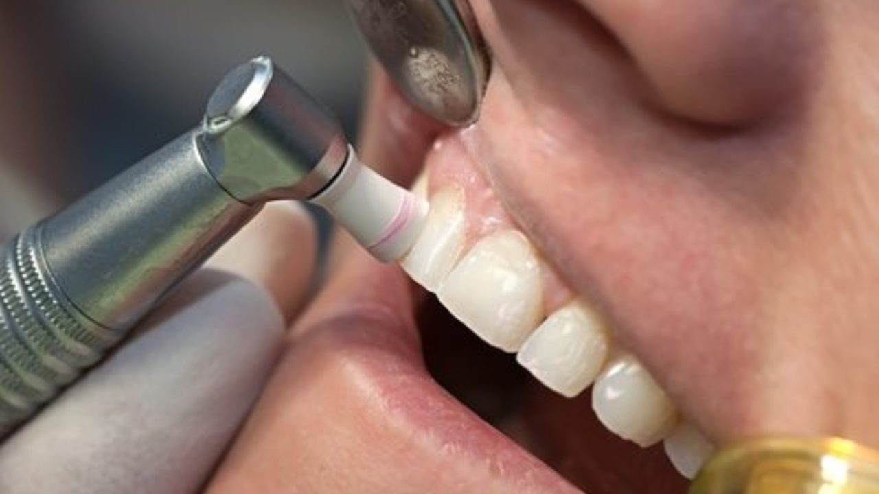 What Is The Cost Of A Routine Dental Cleaning