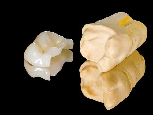 Dental onlay services in Arlington Heights Illinois