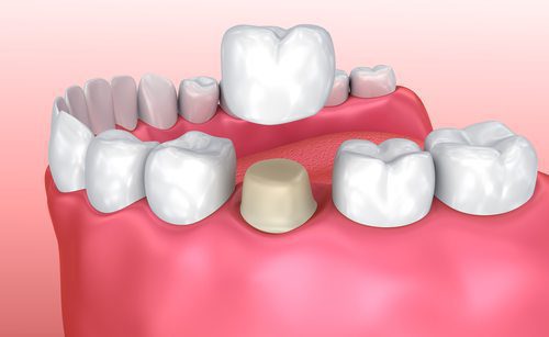 placing same-day crowns in Arlington Heights IL