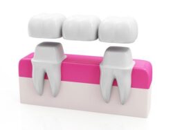 Dental bridges in Arlington Heights IL