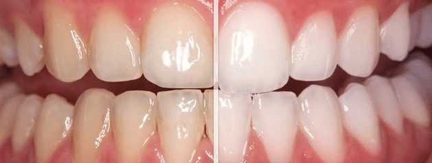 Patient before and after teeth whitening in Arlington Heights, IL