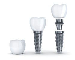 dental implant restoration Arlington Heights, IL