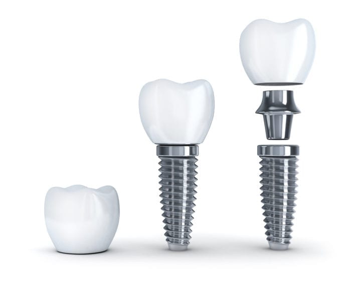 dental implants Arlington Heights, IL