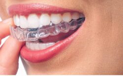 invisalign for adults plano tx