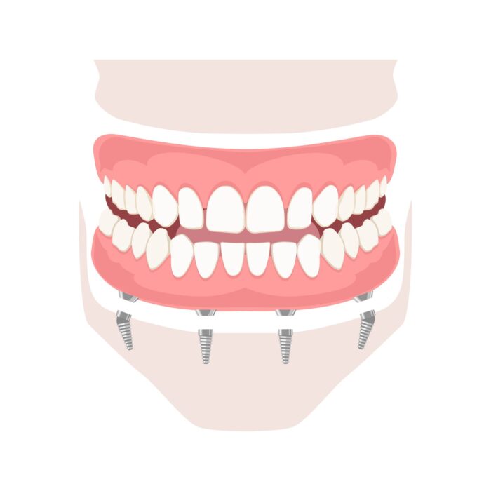 fixed hybrid denture arlington heights il.