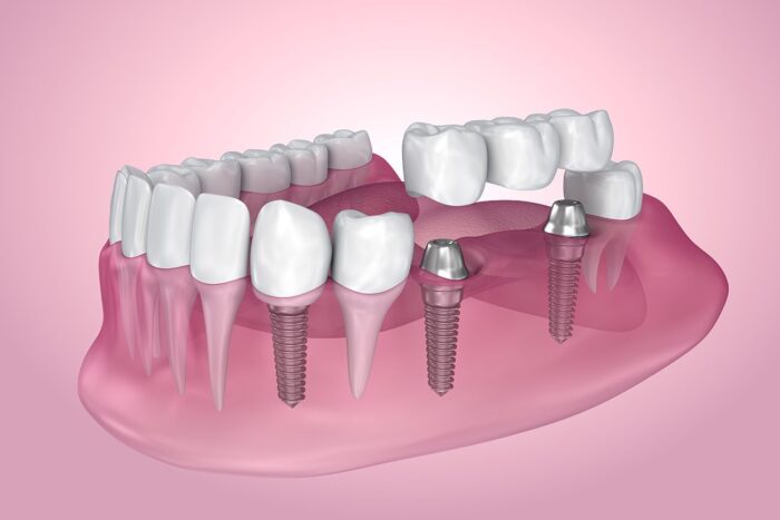 dental implants for lost teeth