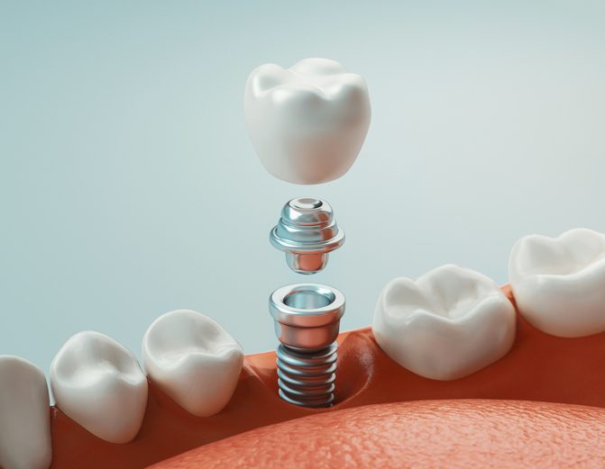Single Dental Implants for a lost missing tooth