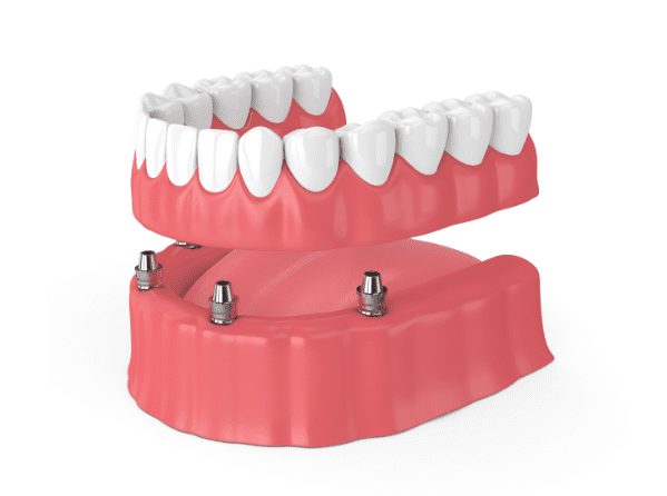 Dental Implants versus Dentures at AH Smiles