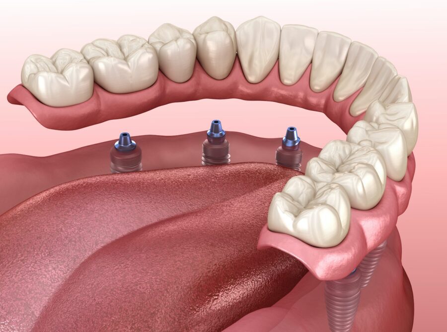 What are Fixed Hybrid Dentures? Arlington Heights, IL Dentist