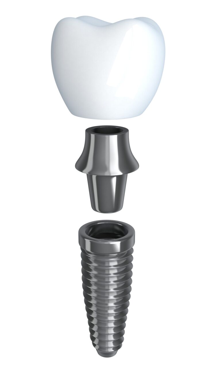 affordable dental implants can replace missing teeth