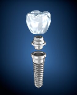dental implant process in Arlington Heights, Illinois