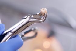 tooth extraction arlington heights