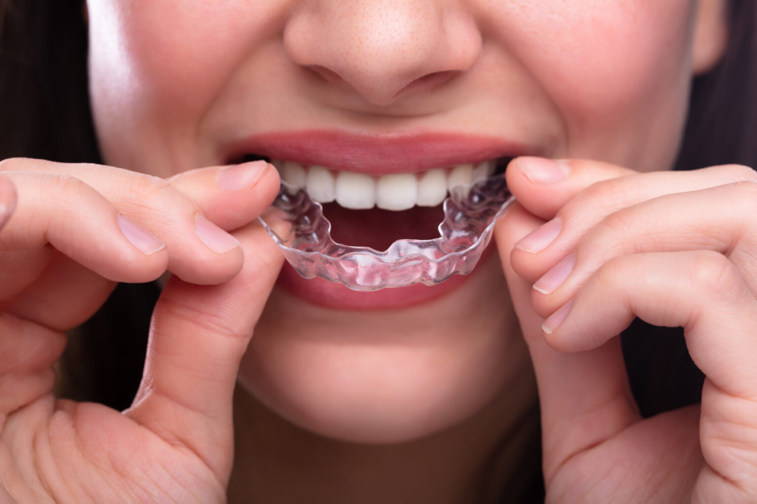 Metal Braces vs. Clear Braces Dentist in Arlington Heights