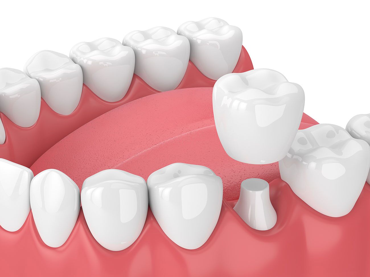 Dental Crown in Arlington Heights IL