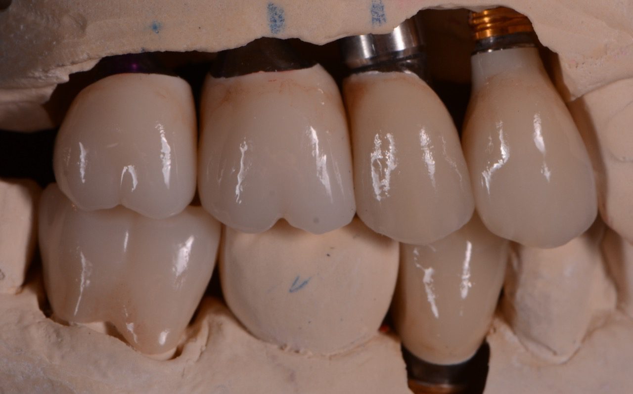 Missing Teeth in Arlington Heights, IL