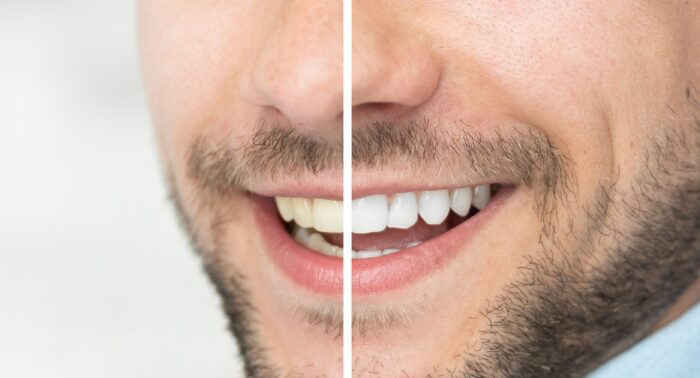 tooth discoloration in Arlington Heights, IL