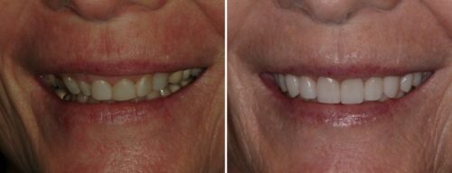 Results after dentistry at AH Smiles