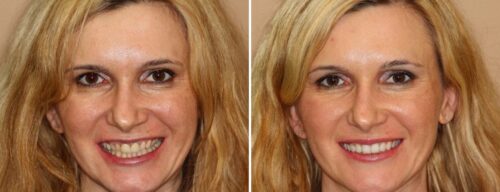 Results after dentistry at AH Smiles