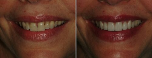 Results after dentistry at AH Smiles