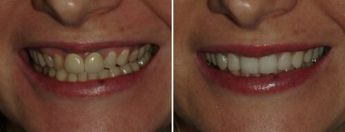 Results after dentistry at AH Smiles