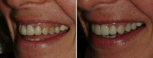 Results after dentistry at AH Smiles