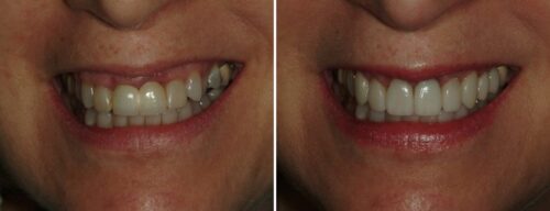 Results after dentistry at AH Smiles