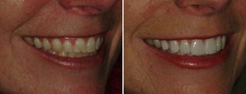 Results after dentistry at AH Smiles