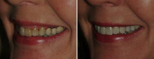 Results after dentistry at AH Smiles