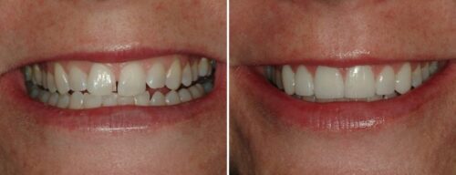 Results after dentistry at AH Smiles