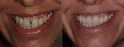 Results after dentistry at AH Smiles